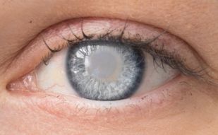 Cataract Surgery