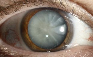 FEMTO Cataract Surgery