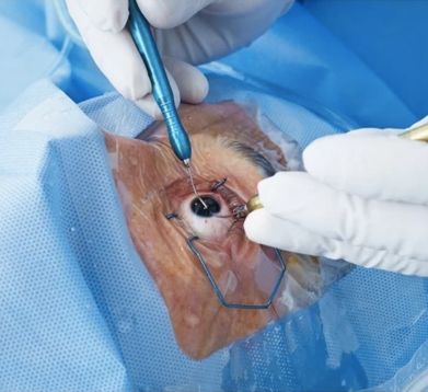 Cataract Surgery