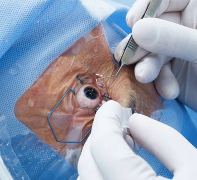 FEMTO Cataract Surgery