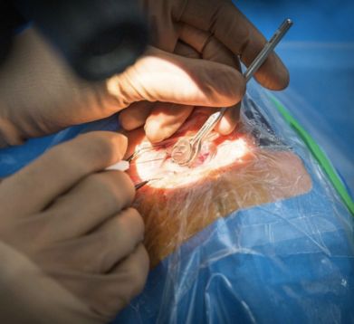Glaucoma Surgery
